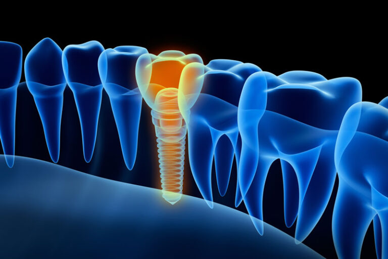 Read more about the article Dental Implants from an Oral Surgeon
