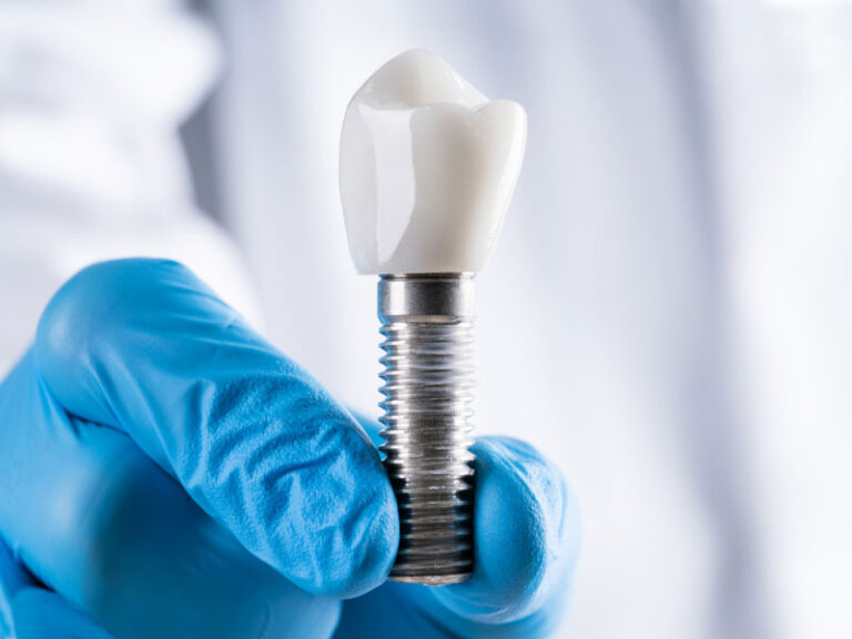 Read more about the article The Dental Implant Process: Restoring Your Smile with Confidence