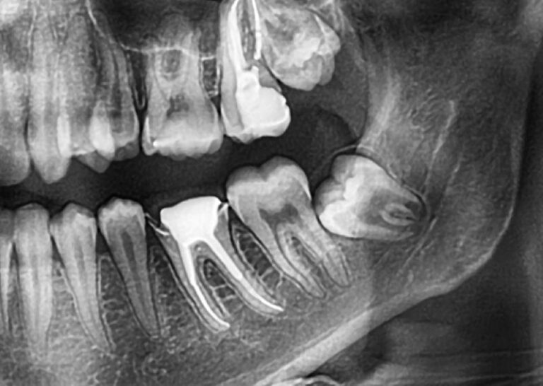 Read more about the article The Importance of Wisdom Teeth Removal