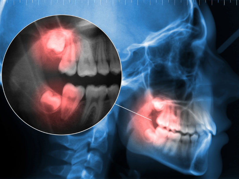 Read more about the article Trust Our Oral Surgeons for Wisdom Teeth Removal